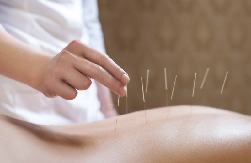 La acupuntura