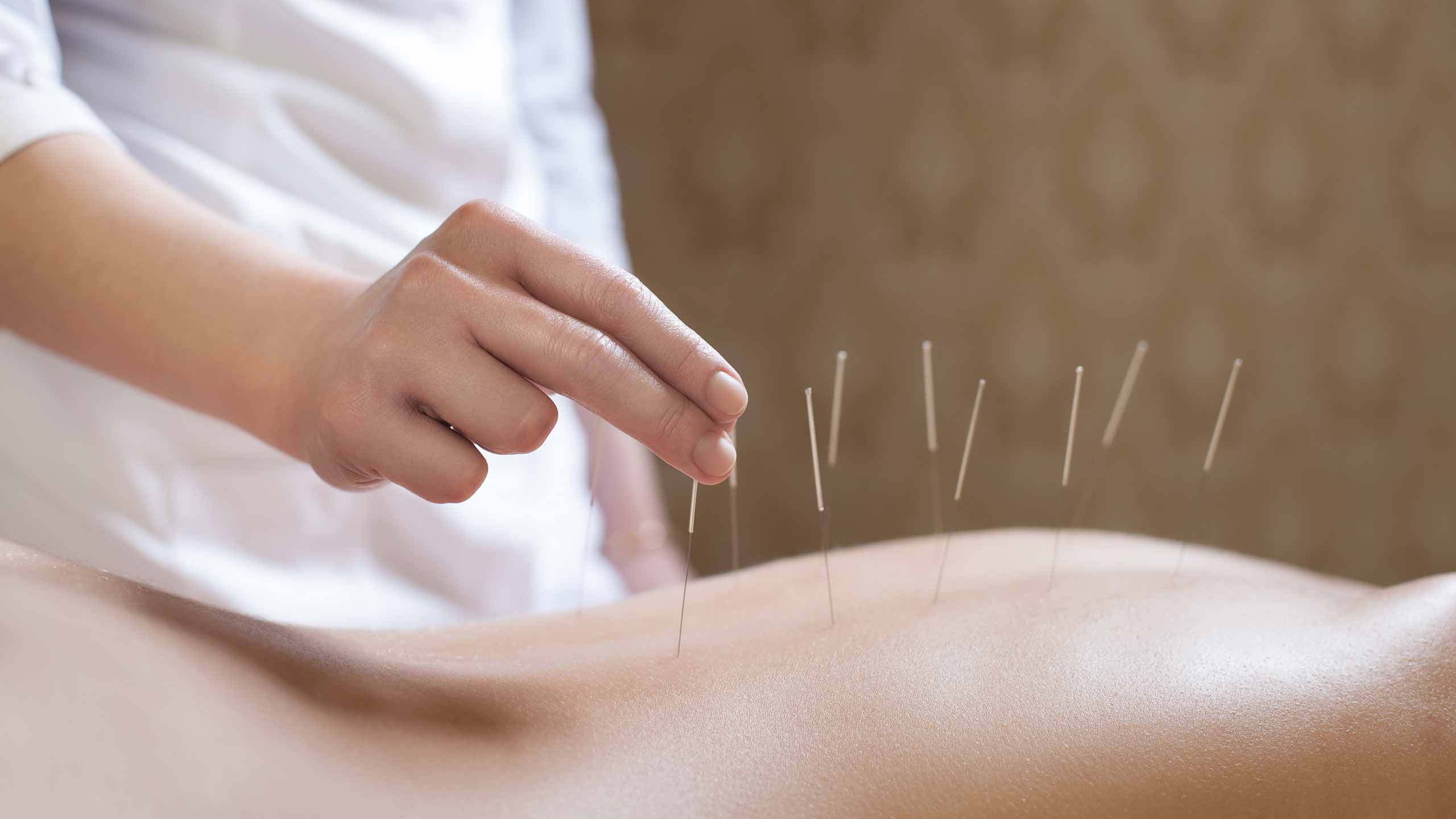Acupuncture needles inserted in a person's back during treatment.